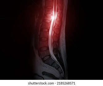 MRI Lumbar Spine Sagittal T2W Fat Suppression.