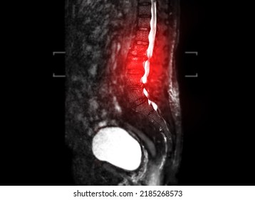 MRI Lumbar Spine Sagittal T2W Fat Suppression.