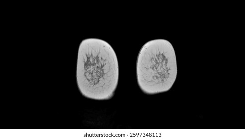 MRI scan of the breasts in an Coronal view with contrast enhancement, highlighting vascular structures and tissue composition. Used for breast cancer screening and diagnostic evaluation.