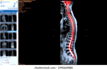 MRI Of Whole Spine  T2W Sagittal  Plane For Diagnostic Spinal Cord Compression.