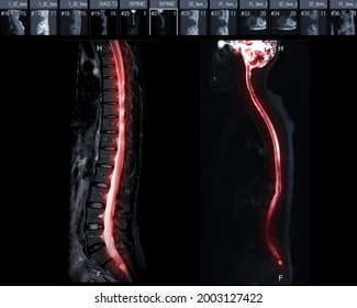 MRI Of Whole Spine  T2W Sagittal  Plane For Diagnostic Spinal Cord Compression.