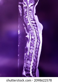 MRI Of Whole Spine T2W Sagittal Plane For Diagnostic Spinal Cord Metastases. Illustration