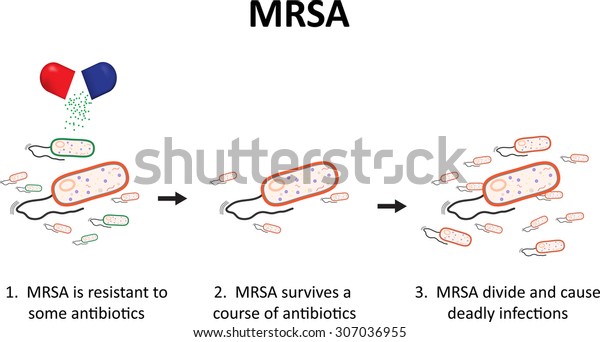 Mrsa Stock Illustration 307036955