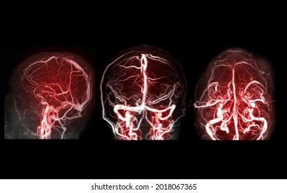 Mrv Brain Magnetic Resonance Venography Brain Stock Illustration ...