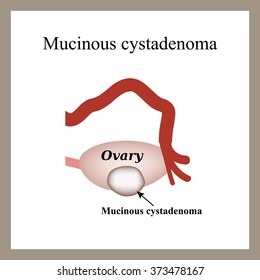 Mucinous Cyst On Ovary Cystadenoma Ovary Stock Illustration 373478167 ...