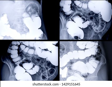 Multi Screen Of Barium Enema Image Or BE  Showing Air And Barium Sulphate In Colon Or Large Intestine For Detect Colon Cancer.  