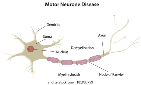 Motor Neuron Disease Images Stock Photos Vectors Shutterstock