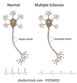 Multiple Sclerosis