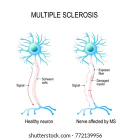 Multiple Sclerosis Ms Autoimmune Disease Nerves Stock Illustration ...