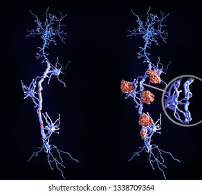 Multiple sclerosis (MS): heatlhy neuron with intact myelin sheaths (left), neuron affected by MS (right) 
Microglia cells attack the oligodendrocytes that form the  myelin sheath. 3d rendering