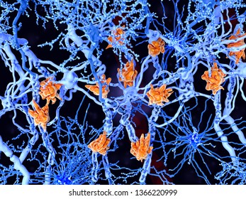 Multiple sclerosis (MS): microglia cells (orange) damage the myelin sheath of neuron axons leading to a loss of the nerve function. 3d rendering