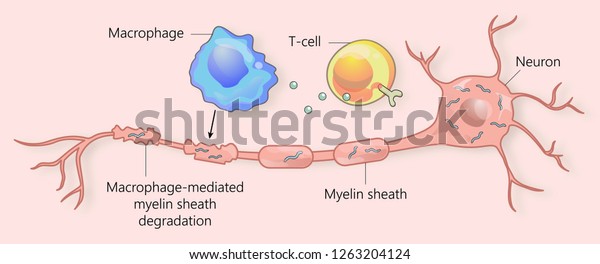 Multiple Sclerosis Myelin Sheath Breakdown Stock Illustration 1263204124 Multiple Sclerosis Myelin Sheath Breakdown Stock Illustration 1263204124