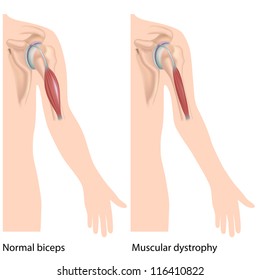 Muscular Dystrophy