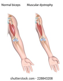 Muscular Dystrophy Versus Normal Unlabeled.