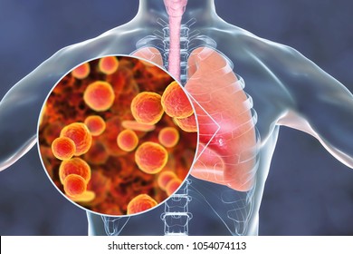 Mycoplasma Pneumoniae Bacteria In Human Lungs, 3D Illustration. Medical Concept For Mycoplasma Pneumonia