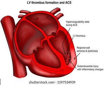 Myocardial Infarction With Mural Thrombus Formation. 