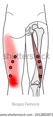 Myofascial Trigger Point, Hamstrings Biceps Femoris