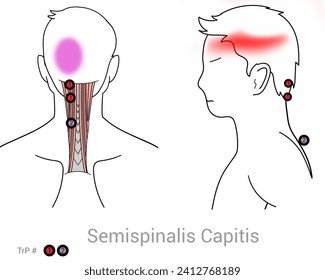 Myofascial Trigger Points, Semispinalis Capitis