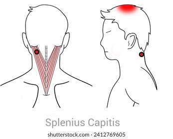  Myofascial Trigger Points, Splenius Capitis
