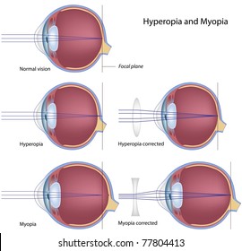 Myopia And Hyperopia