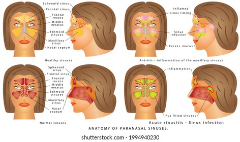 Nasal Sinus. Human Anatomy - Sinus Diagram. Anatomy Of The Nose. Nasal Cavity Bones. Anatomy Of Paranasal Sinuses. Sinusitis - Antritis - It Is The Inflammation Of The Maxillary Sinuses.