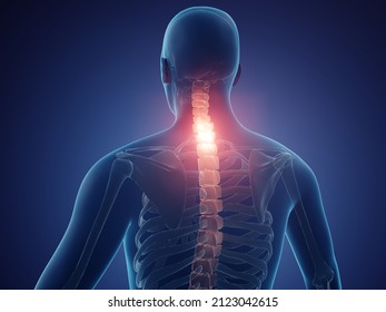 Neck Pain Is Often Caused By Poor Posture Or Bad Sleep Habits, 3d Illustration