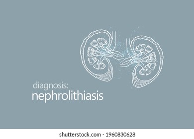 Nephrolithiasis kidney stones disease or urolithiasis. Renal Calculus or Stones blocking the urinary tract. Minimalistic style design template with handrawn organ on grey background.