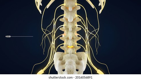 370 Hernia 3d Images, Stock Photos & Vectors | Shutterstock