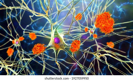 Neurons In Alzheimer's Disease. 3D Illustration Showing Amyloid Plaques In Brain Tissue, Neurofibrillary Tangles And Distruction Of Neuronal Networks