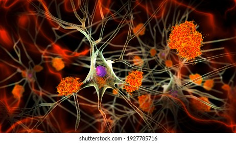 Neurons In Alzheimer's Disease. 3D Illustration Showing Amyloid Plaques In Brain Tissue, Neurofibrillary Tangles And Distruction Of Neuronal Networks