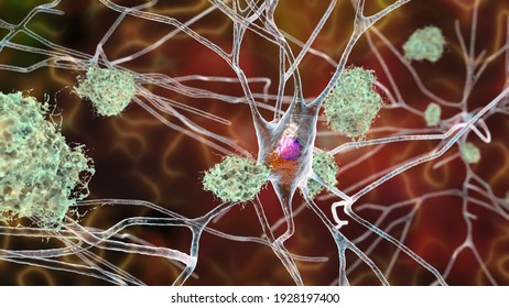 Neurons In Alzheimer's Disease. 3D Illustration Showing Amyloid Plaques In Brain Tissue, Neurofibrillary Tangles And Distruction Of Neuronal Networks