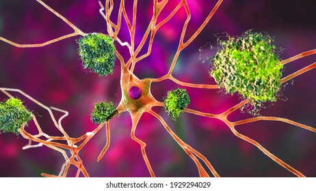 Neurons In Alzheimer's Disease. 3D Illustration Showing Amyloid Plaques In Brain Tissue, Neurofibrillary Tangles And Distruction Of Neuronal Networks