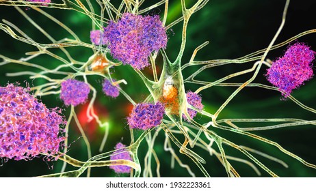 Neurons In Alzheimer's Disease. 3D Illustration Showing Amyloid Plaques In Brain Tissue, Neurofibrillary Tangles And Distruction Of Neuronal Networks