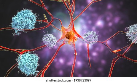 Neurons In Alzheimer's Disease. 3D Illustration Showing Amyloid Plaques In Brain Tissue, Neurofibrillary Tangles And Distruction Of Neuronal Networks