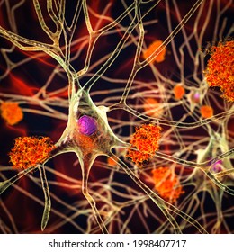 Neurons In Alzheimer's Disease. 3D Illustration Showing Amyloid Plaques In Brain Tissue, Neurofibrillary Tangles And Distruction Of Neuronal Networks