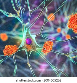 Neurons In Alzheimer's Disease. 3D Illustration Showing Amyloid Plaques In Brain Tissue, Neurofibrillary Tangles And Distruction Of Neuronal Networks