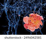 Neurons with Lewy bodies. Lewy bodies develop inside nerve cells in Parkinson