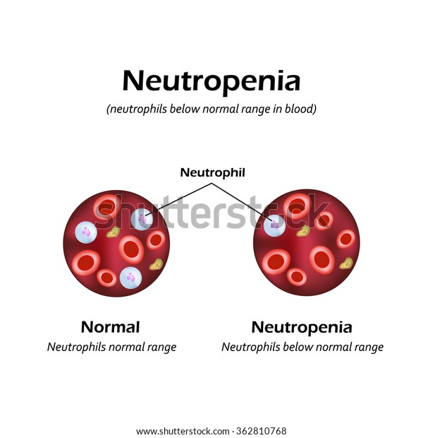 Neutrophils Below Normal Range Blood Neutropenia Stock Illustration ...