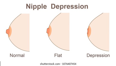 Nipple  depression  shape