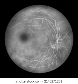 Non-proliferative Diabetic Retinopathy, Illustration Showing Small Retinal Haemorrhages, Ophthalmoscope View, Fluorescein Angiography