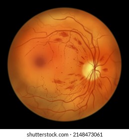 Non-proliferative diabetic retinopathy, illustration showing microaneurysms, dot haemorrhages, flame-shaped and splinter retinal haemorrhages, ophthalmoscope view