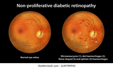 Non-proliferative diabetic retinopathy, illustration showing normal eye retina and retina with microaneurysms, dot haemorrhages, flame-shaped and splinter retinal haemorrhages, ophthalmoscope view