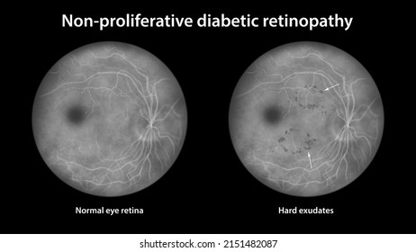 Non-proliferative Diabetic Retinopathy, Illustration Showing Normal Eye Retina And Retina With Hard Exudates (irregularly Shaped Dark Spots), Fluorescein Angiography