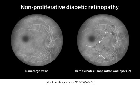 Non-proliferative Diabetic Retinopathy, Illustration Showing Normal Eye Retina And Retina With Hard Exudates, And Cotton Wool Spots, Fluorescein Angiography