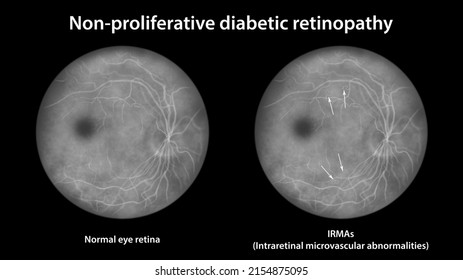 Non-proliferative Diabetic Retinopathy, Illustration Showing Normal Eye Retina And Retina With IRMAs (intraretinal Microvascular Abnormalities), Fluorescein Angiography