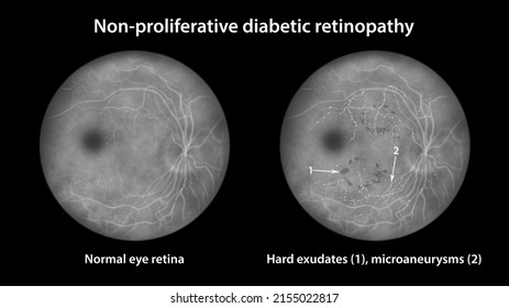 Non-proliferative Diabetic Retinopathy, Illustration Showing Normal Eye Retina And Retina With Hard Exudates And Microaneurysms, Fluorescein Angiography