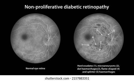 Non-proliferative diabetic retinopathy, illustration showing normal eye retina and retina with hard exudates, microaneurysms, dot haemorrhages, flame-shaped and splinter retinal haemorrhages