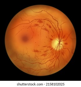 Non-proliferative diabetic retinopathy, illustration showing IRMAs (intraretinal microvascular abnormalities), microaneurysms, dot haemorrhages, flame-shaped and splinter retinal haemorrhages