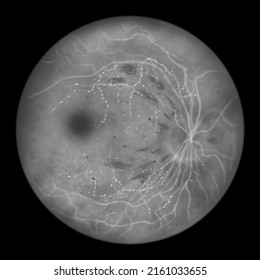 Non-proliferative diabetic retinopathy, illustration shows IRMAs (intraretinal microvascular abnormalities), microaneurysms, dot, flame-shaped and splinter haemorrhages, fluorescein angiography