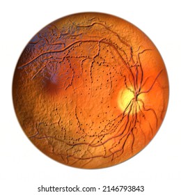 Non-proliferative Diabetic Retinopathy, Ophthalmoscope View, Fluorescein Angiography, 3D Illustration Showing Multiple Microaneurysms